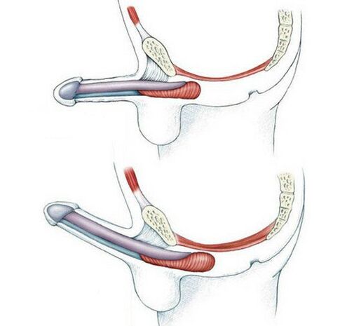 Penis ohne Pubococcygeus-Muskeltraining und danach